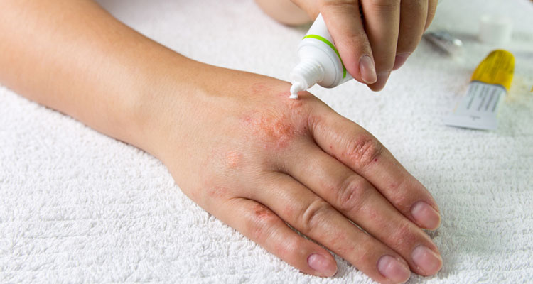 Top 10 best and most effective ringworm treatment products